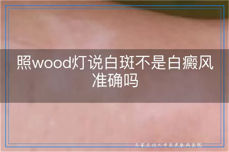 照wood灯说白斑不是白癜风准确吗
