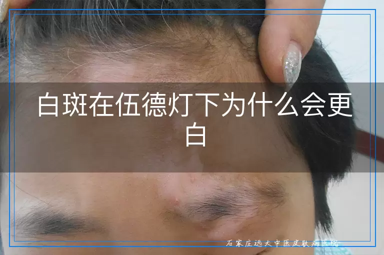 白斑在伍德灯下为什么会更白