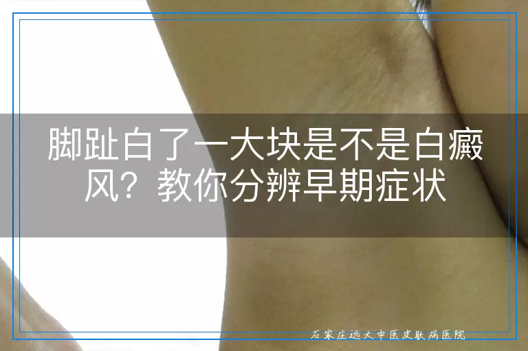 脚趾白了一大块是不是白癜风?教你分辨早期症状
