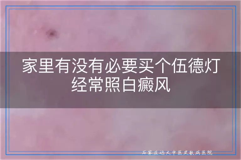 家里有没有必要买个伍德灯经常照白癜风