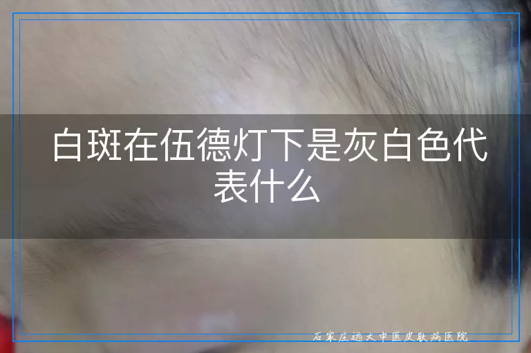 白斑在伍德灯下是灰白色代表什么