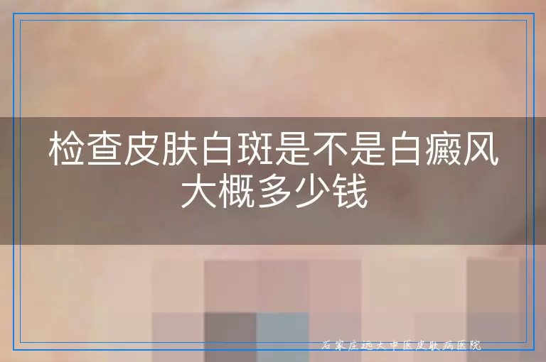 检查皮肤白斑是不是白癜风大概多少钱
