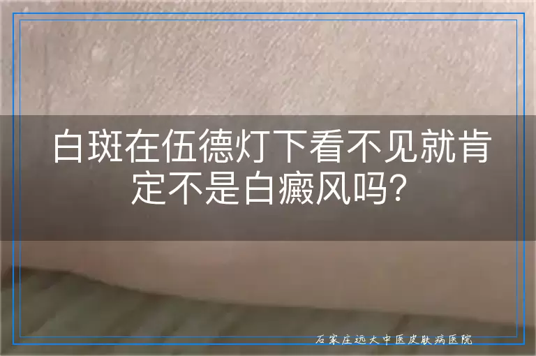 白斑在伍德灯下看不见就肯定不是白癜风吗?