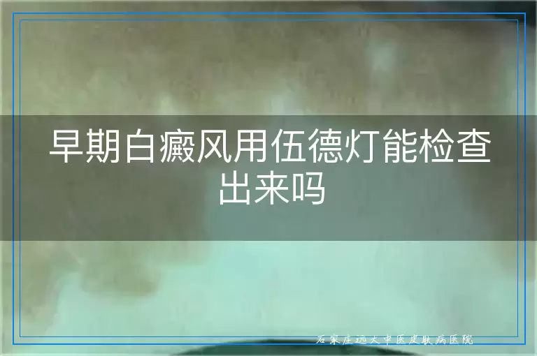 早期白癜风用伍德灯能检查出来吗