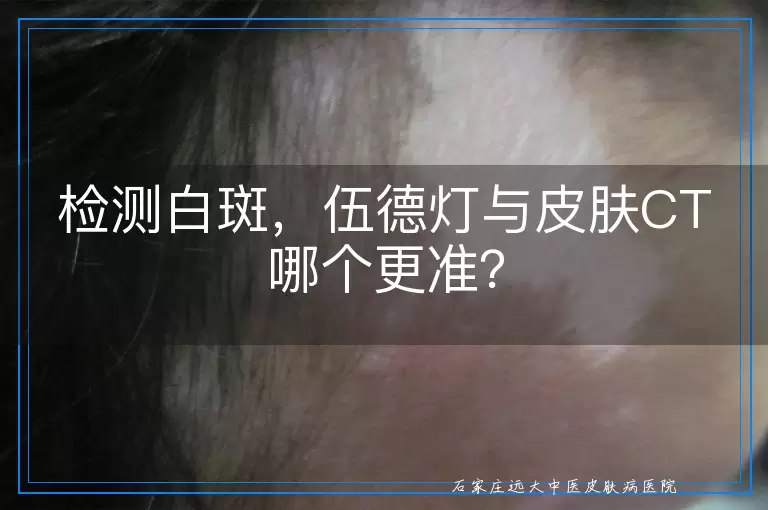 检测白斑,伍德灯与皮肤CT哪个更准?