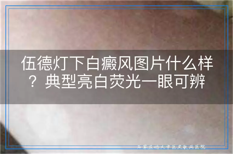 伍德灯下白癜风图片什么样?典型亮白荧光一眼可辨