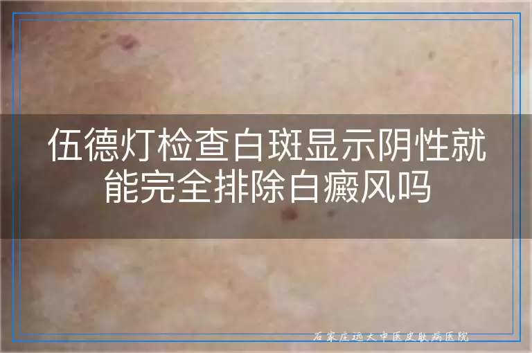 伍德灯检查白斑显示阴性就能完全排除白癜风吗
