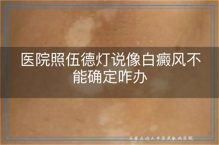 医院照伍德灯说像白癜风不能确定咋办