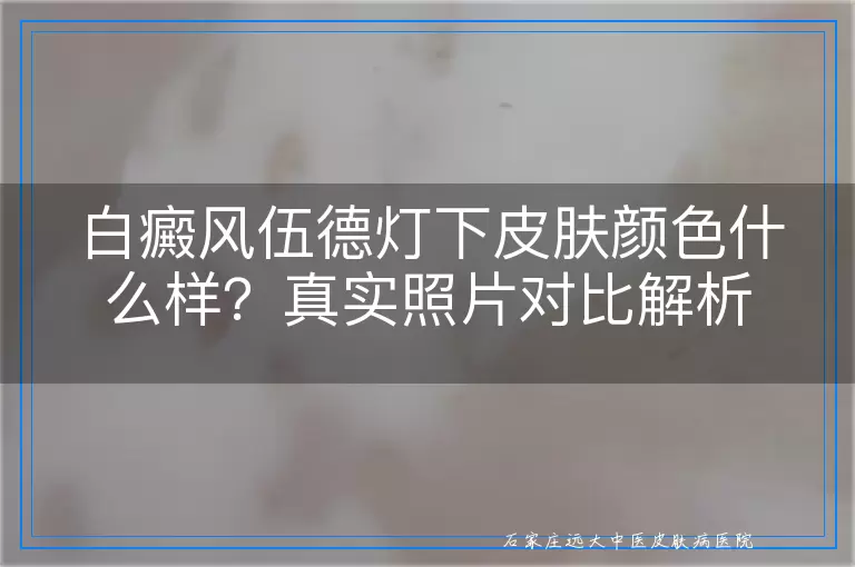 白癜风伍德灯下皮肤颜色什么样?真实照片对比解析