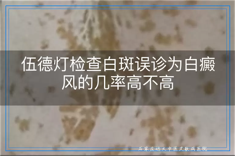 伍德灯检查白斑误诊为白癜风的几率高不高