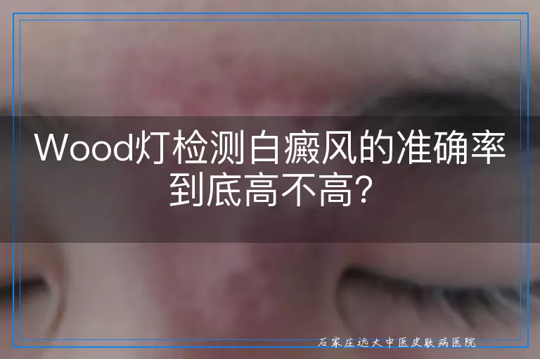 Wood灯检测白癜风的准确率到底高不高?