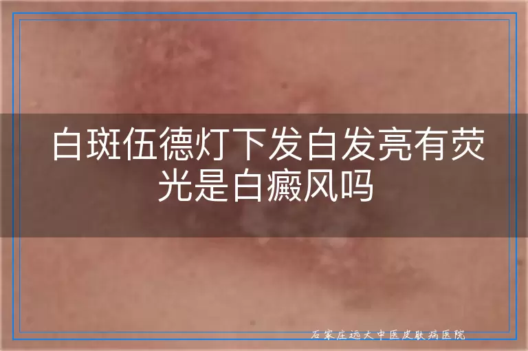 白斑伍德灯下发白发亮有荧光是白癜风吗