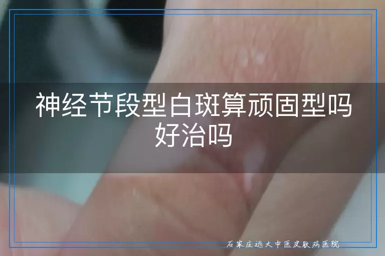 神经节段型白斑算顽固型吗好治吗