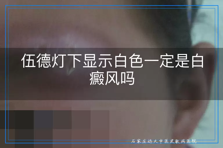 伍德灯下显示白色一定是白癜风吗
