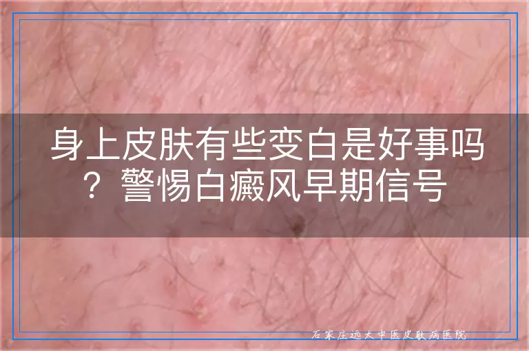 身上皮肤有些变白是好事吗?警惕白癜风早期信号