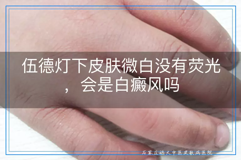 伍德灯下皮肤微白没有荧光，会是白癜风吗