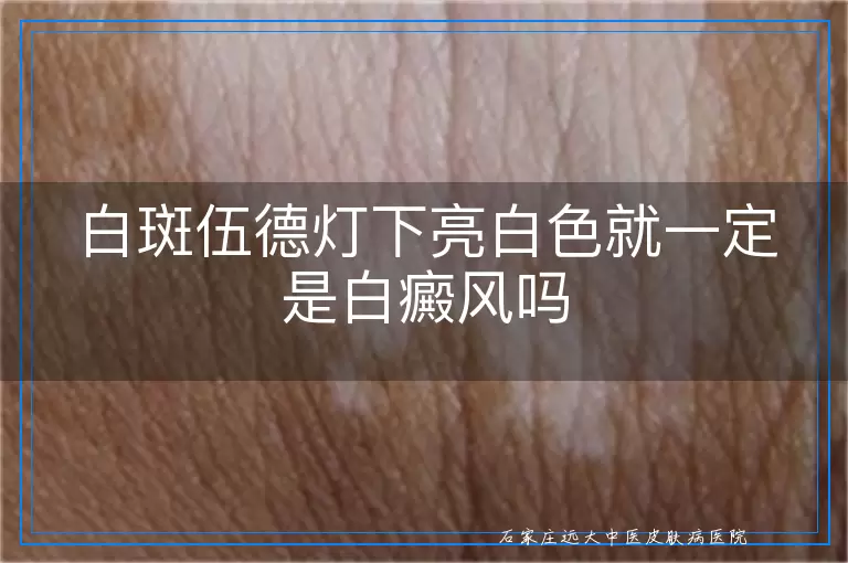 白斑伍德灯下亮白色就一定是白癜风吗