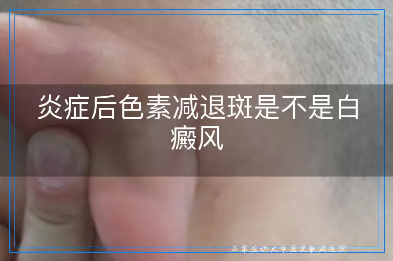 炎症后色素减退斑是不是白癜风