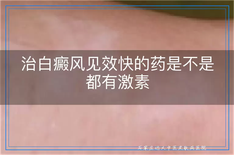治白癜风见效快的药是不是都有激素
