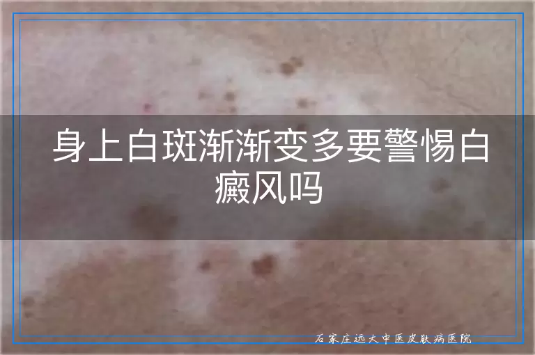 身上白斑渐渐变多要警惕白癜风吗