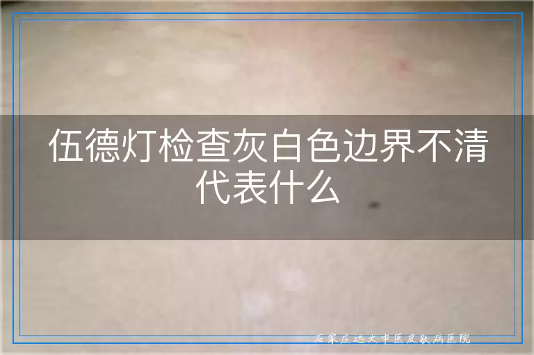 伍德灯检查灰白色边界不清代表什么