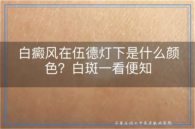 白癜风在伍德灯下是什么颜色?白斑一看便知