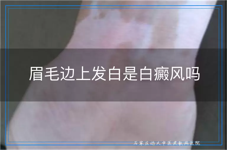 眉毛边上发白是白癜风吗