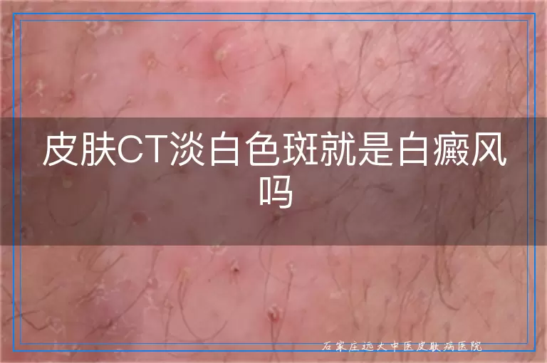 皮肤CT淡白色斑就是白癜风吗