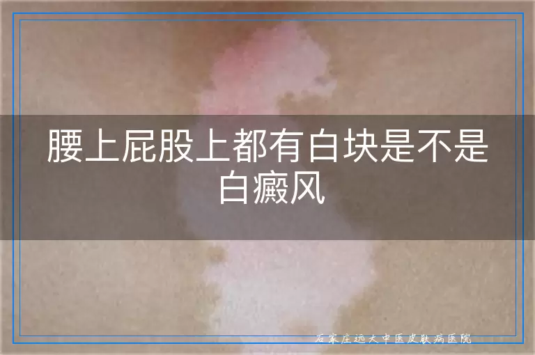 腰上屁股上都有白块是不是白癜风