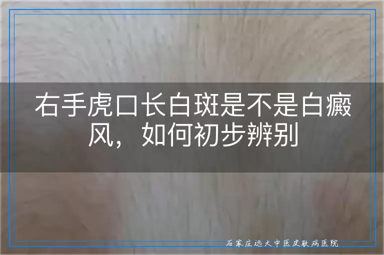 右手虎口长白斑是不是白癜风,如何初步辨别