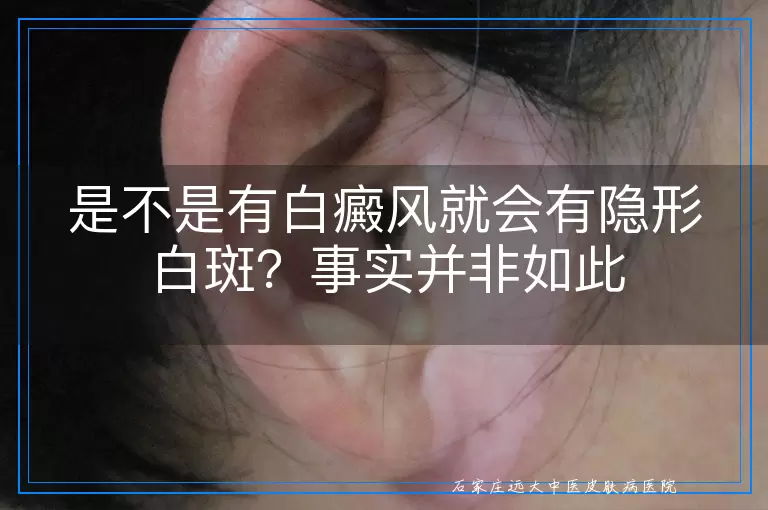 是不是有白癜风就会有隐形白斑？事实并非如此
