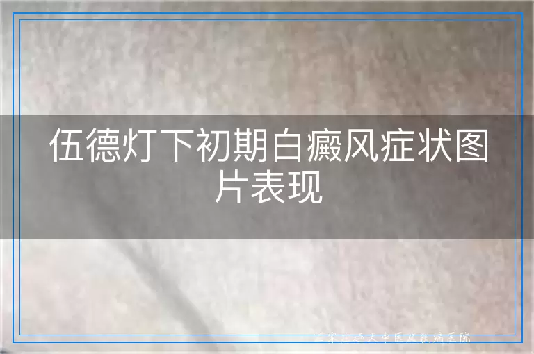伍德灯下初期白癜风症状图片表现