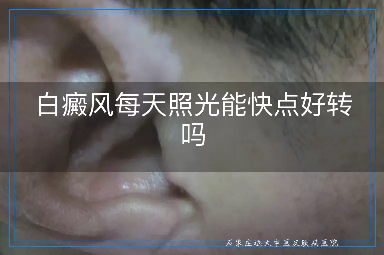 白癜风每天照光能快点好转吗