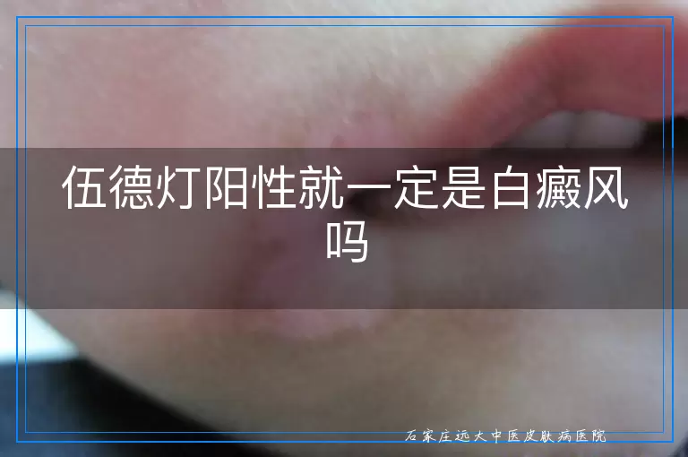 伍德灯阳性就一定是白癜风吗
