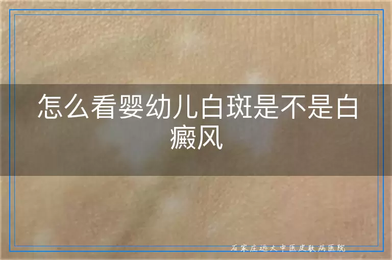 怎么看婴幼儿白斑是不是白癜风