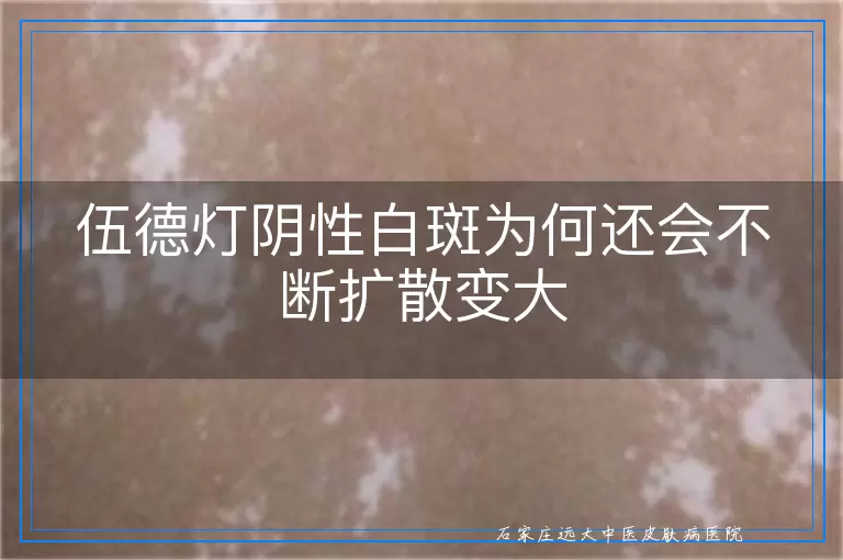 伍德灯阴性白斑为何还会不断扩散变大