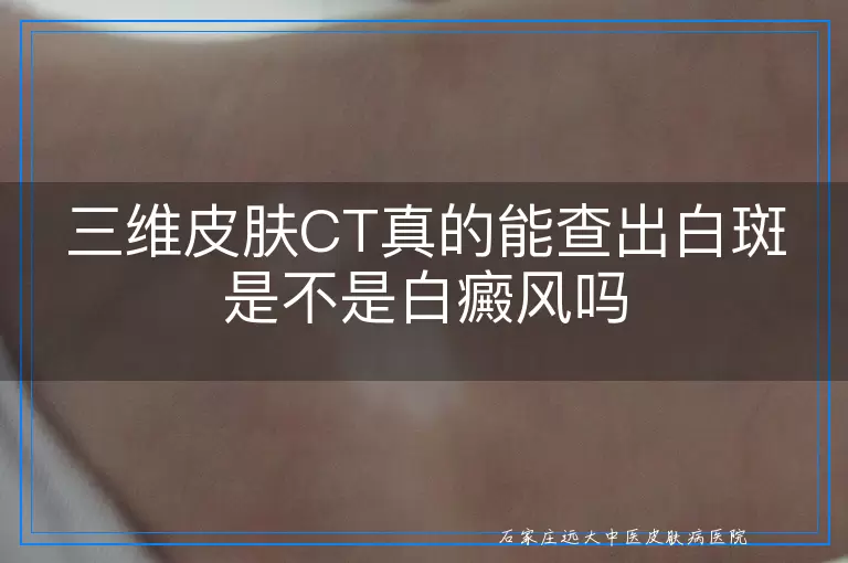 三维皮肤CT真的能查出白斑是不是白癜风吗