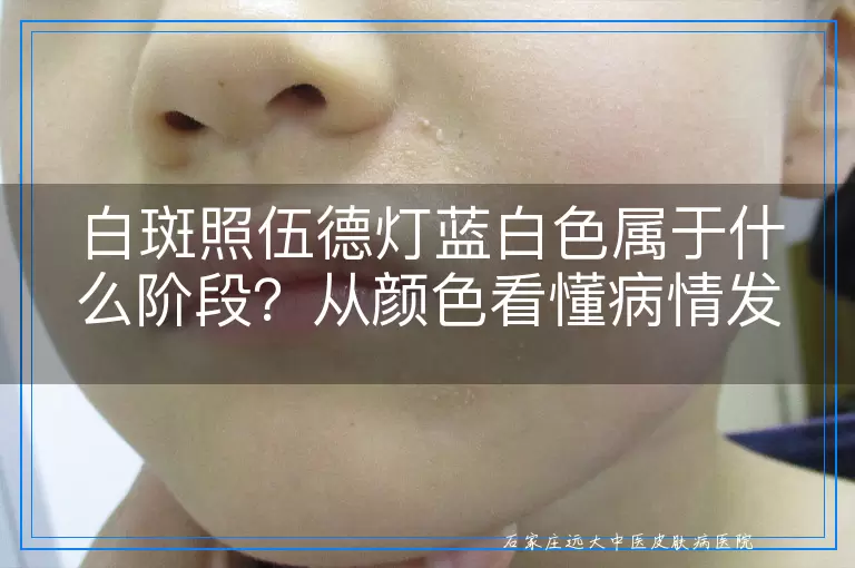 白斑照伍德灯蓝白色属于什么阶段?从颜色看懂病情发展