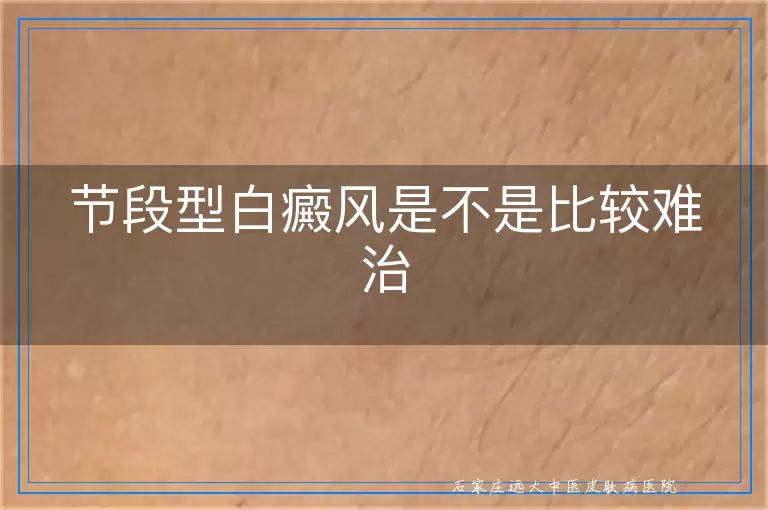 节段型白癜风是不是比较难治