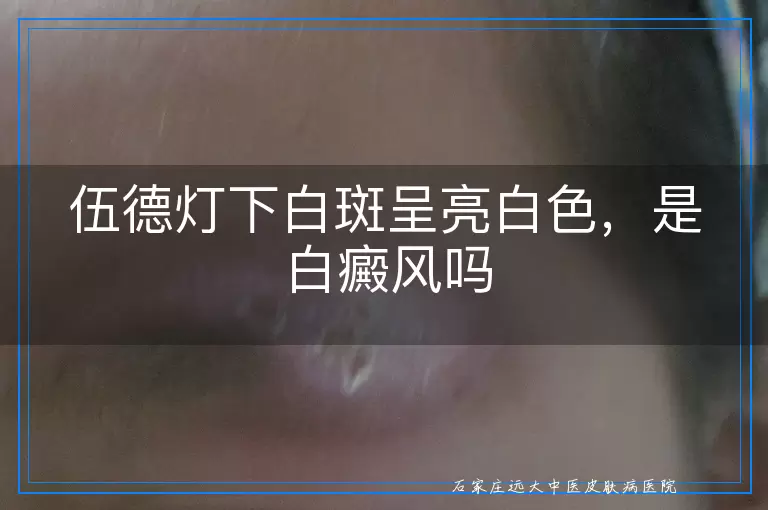 伍德灯下白斑呈亮白色,是白癜风吗