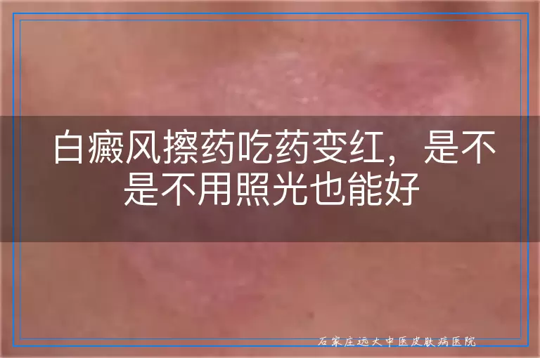 白癜风擦药吃药变红,是不是不用照光也能好