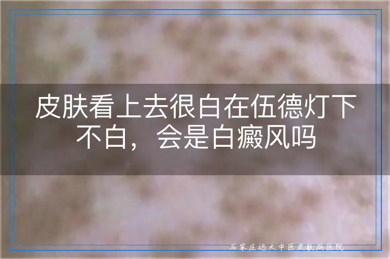 皮肤看上去很白在伍德灯下不白,会是白癜风吗