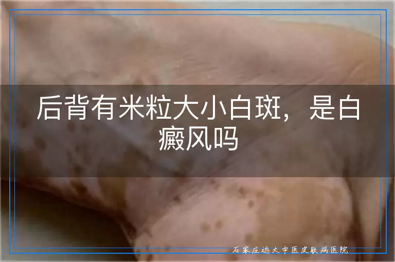 后背有米粒大小白斑,是白癜风吗