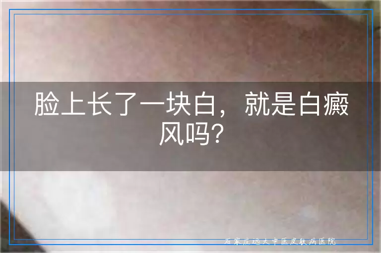 脸上长了一块白，就是白癜风吗？