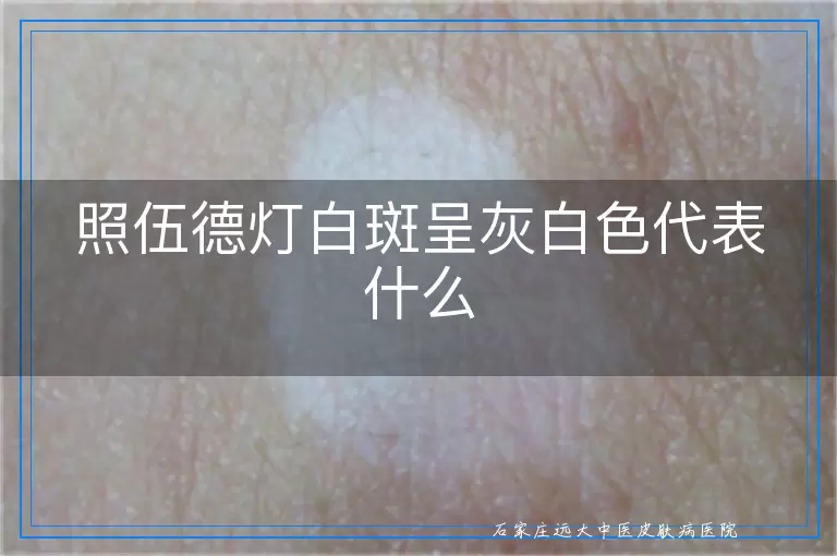 照伍德灯白斑呈灰白色代表什么