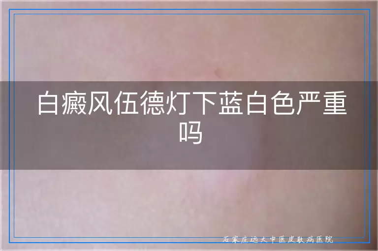 白癜风伍德灯下蓝白色严重吗