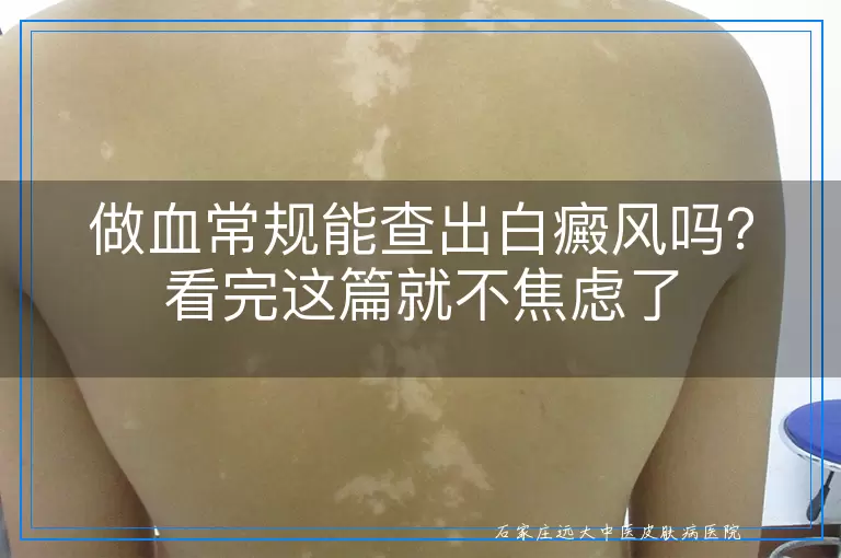 做血常规能查出白癜风吗?看完这篇就不焦虑了