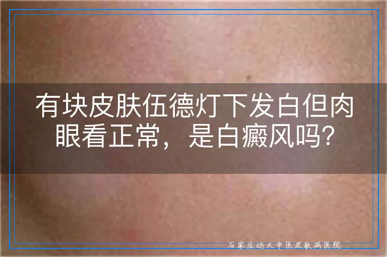 有块皮肤伍德灯下发白但肉眼看正常，是白癜风吗？