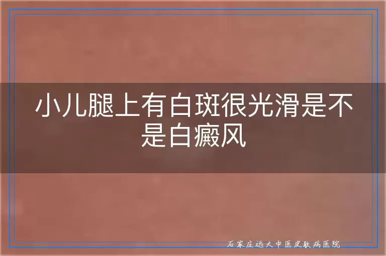小儿腿上有白斑很光滑是不是白癜风