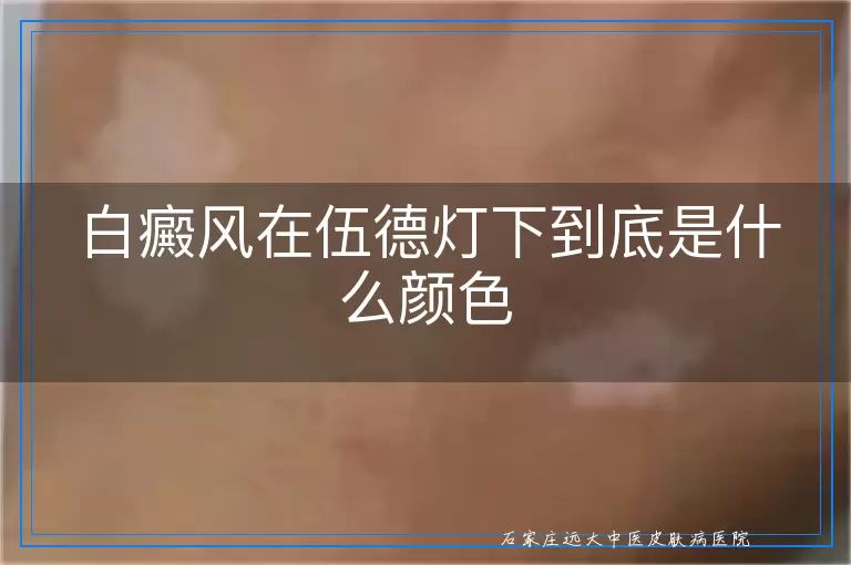 白癜风在伍德灯下到底是什么颜色